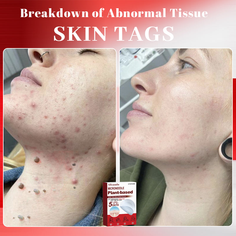 Alisanda™ MicroNeedle Plant-Based Skin Tag Removal Patch 🇺🇸 Made in the USA