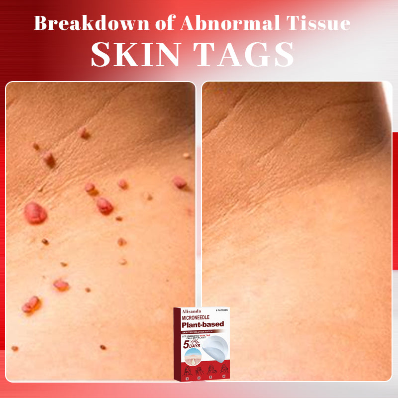 Alisanda™ MicroNeedle Plant-Based Skin Tag Removal Patch 🇺🇸 Made in the USA