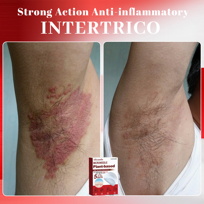 Alisanda™ MicroNeedle Plant-Based Skin Tag Removal Patch 🇺🇸 Made in the USA