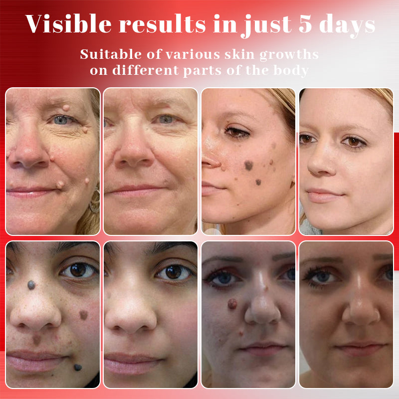 Alisanda™ MicroNeedle Plant-Based Skin Tag Removal Patch 🇺🇸 Made in the USA