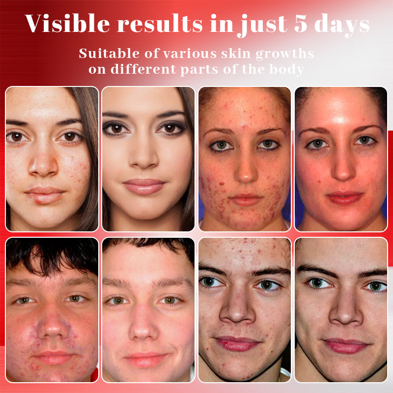 Alisanda™ MicroNeedle Plant-Based Skin Tag Removal Patch 🇺🇸 Made in the USA