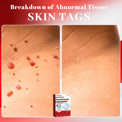 Alisanda™ MicroNeedle Plant-Based Skin Tag Removal Patch 🇺🇸 Made in the USA
