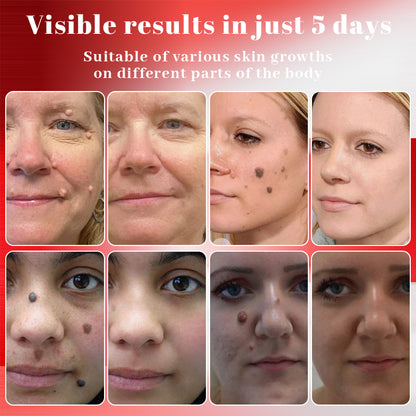 Alisanda™ MicroNeedle Plant-Based Skin Tag Removal Patch 🇺🇸 Made in the USA